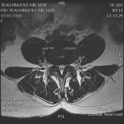Regular MRI Relative Central Spinal Stenosis Lumbar