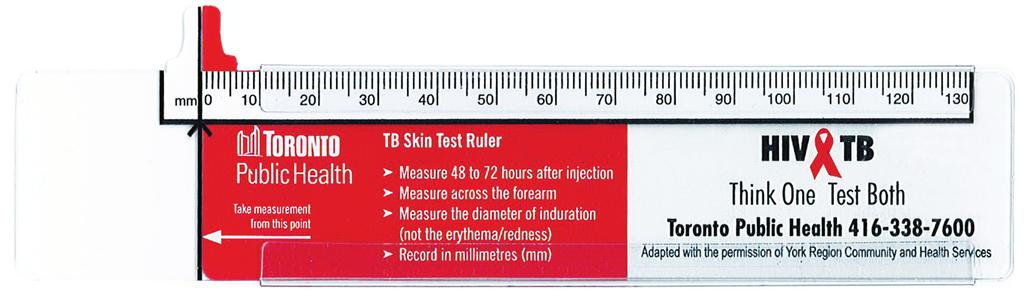 Prepare the Tuberculin (PPD) 3) Inject the Tuberculin 4)