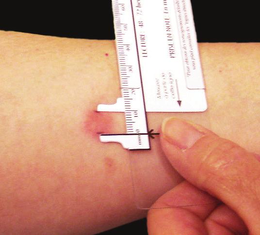 9 Reading the Tuberculin Skin Test (TST) 1) Inspect: 2) Palpate: 3) Mark: 4) Measure: 5) Record Induration in millimetres (mm):