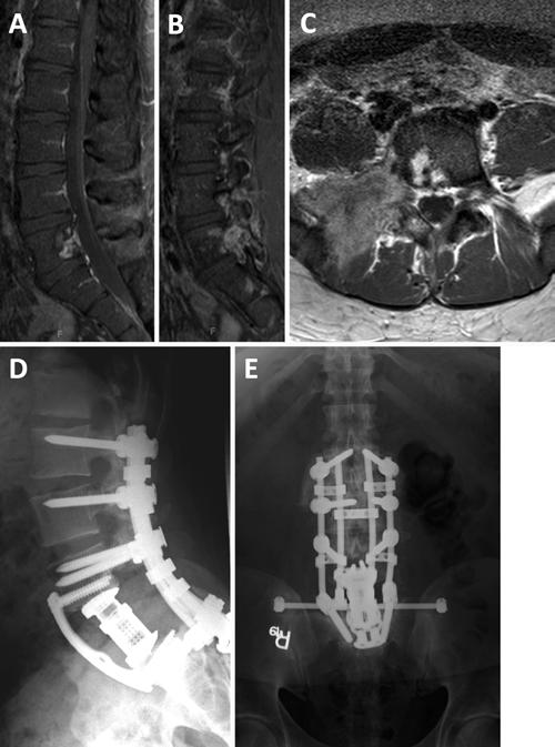 D. M. Sciubba et al. FIG. 3. A 24-year-old man presented with a several-month history of persistent low-back pain and right-sided radiculopathy.