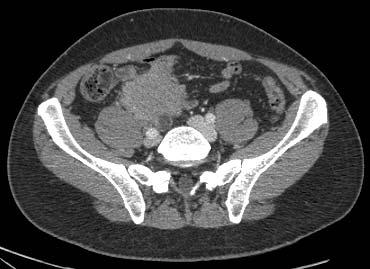Differential diagnosis of retroperitoneal soft tissue mass 43-year-old man with abdominal pain for 6 months