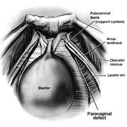 Anterior paravaginal repair 6 studies (vaginal), 5 studies (abdominal) 6 prospective and 5