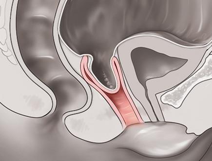 Vaginal Vault Prolapse Similar to uterine prolapse, may be milder generalised symptoms Common after
