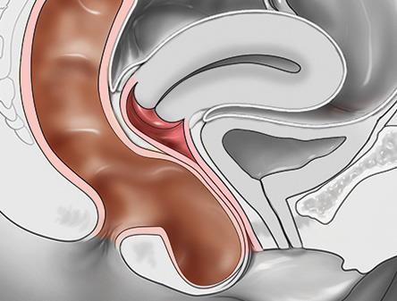 Rectocele Constipation Difficulty defecating May digitally reduce in order to completely