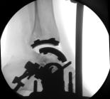 medial malleolar fracture (2), tibial component subsidence