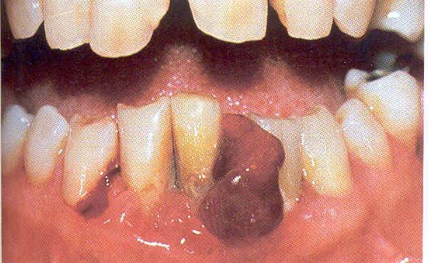 Oral Manifestations * Cervical lymphadenopathy * Oral bleeding * Gingival infiltrates * Oral infections : candidiasis, periodontal disease