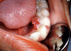 Pregnancy Oral findings Pregnancy ginggivitis - Swelling - Redness - Bleeding