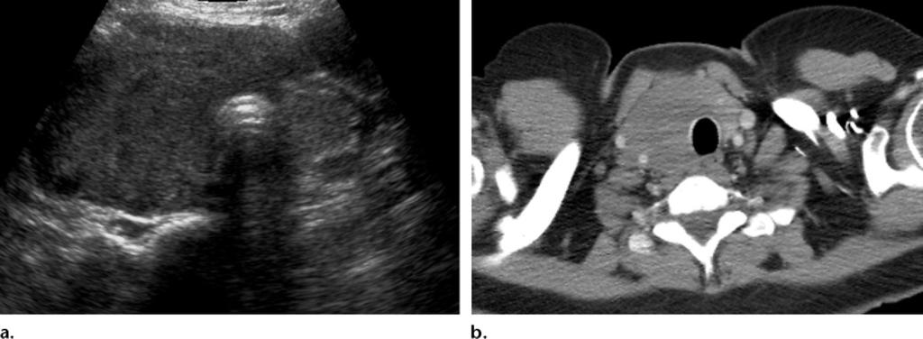 Thyroid involvement in a 46-year-old woman who presented with episodes of choking.