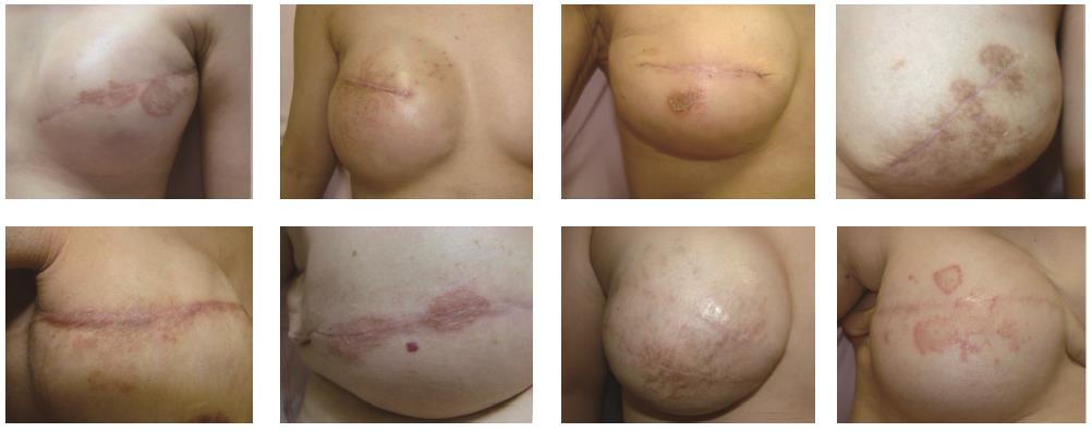 Nummular Dermatitis of the Reconstructed Breast 48/1662 (2.89%) patients developed Variable timing Periwound 41.