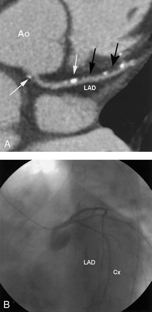(B) Same patient, with conventional coronary angiography: normal aspect of the proximal left and right coronary arteries. Ao aorta; Cx circumflex artery; LAD left anterior descending artery. Figure 2.