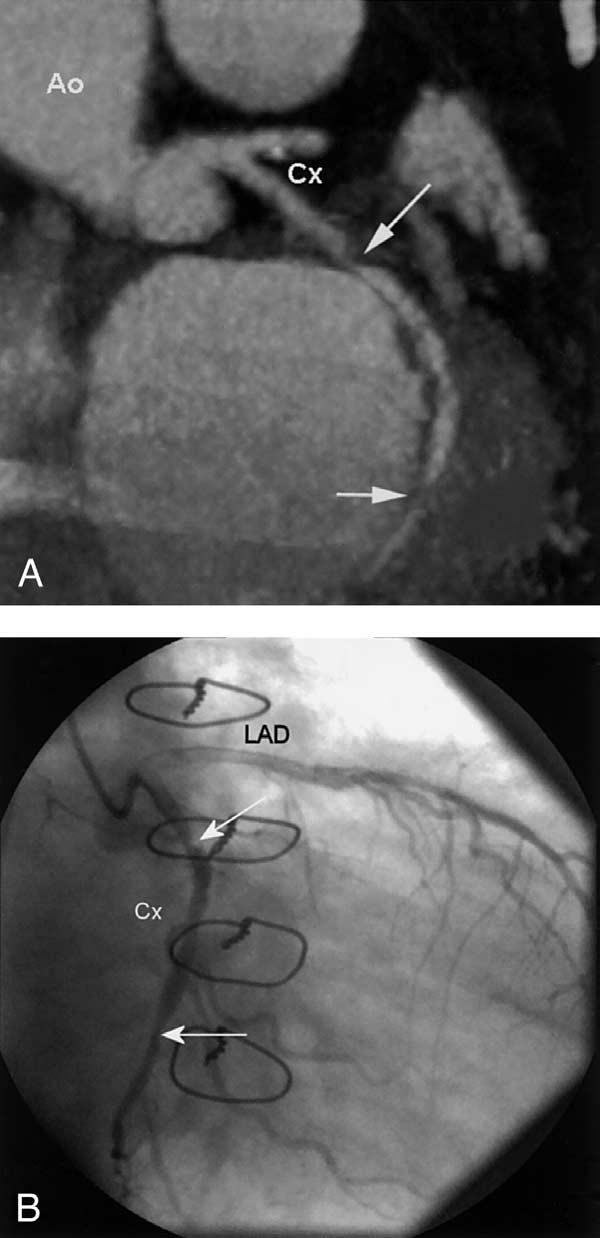 1830 Romeo et al. JACC Vol. 45, No. 11, 2005 16-Slice CT Scan in Heart Transplant Patients June 7, 2005:1826 31 Figure 3.