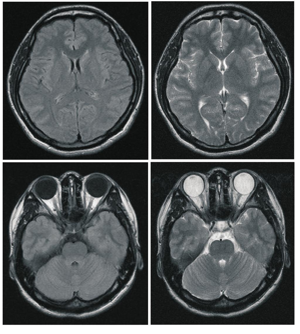 gyrus, midbrain-pontine area, bilateral cerebellum (white arrows in Figs. 1A-2A) and mild high signalintensity lesions on DWI (white arrows in Figs. 1B-2B).
