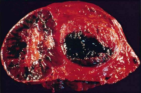 Hepatic Adenoma (HA) From: Tumors of the Liver and Intrahepatic Bile Ducts by Ishak Hepatic Adenoma (HA) Mostly in femals (>30 years), F: M=4:1 Mostly solitary, well circumscribed, round,
