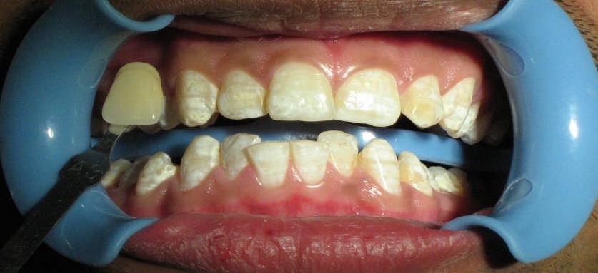 Case report 2 Fig.7. Pre operative photograph Fig.8. Light cured gingival protection dam and the application of whitening agent Pre Operative Photograph Post Operative Photograph Fig.9.