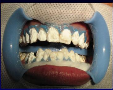 Caustic effects on the oral tissues 5. Dental assistants also subjected to tissue burns during handling 6. Short shelf life of hydrogen peroxide 7.