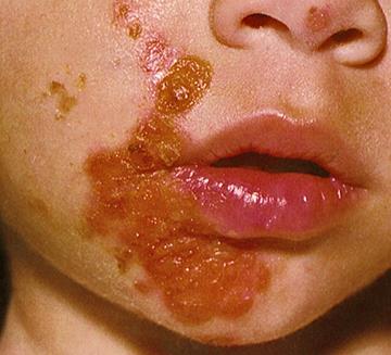 Impetigo Anatomy: Epidermis Clinical Features Most common skin infection in the world Non-bullous (>70% of cases) Typically on face and extremities
