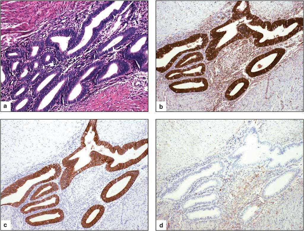 42 K Van Patten et al Figure 2 Gastrointestinal endometriosis staining with (a) hematoxylin and eosin, (b) b-catenin and (c) E-cadherin showing diffuse staining, and (d) N-cadherin showing no