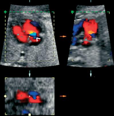 Mild tricuspid regurgitation 607 Hitherto published studies methodologies diagnosed fetal TR by cross-sectional imaging and color flow mapping of the fetal heart, with specific attention to the