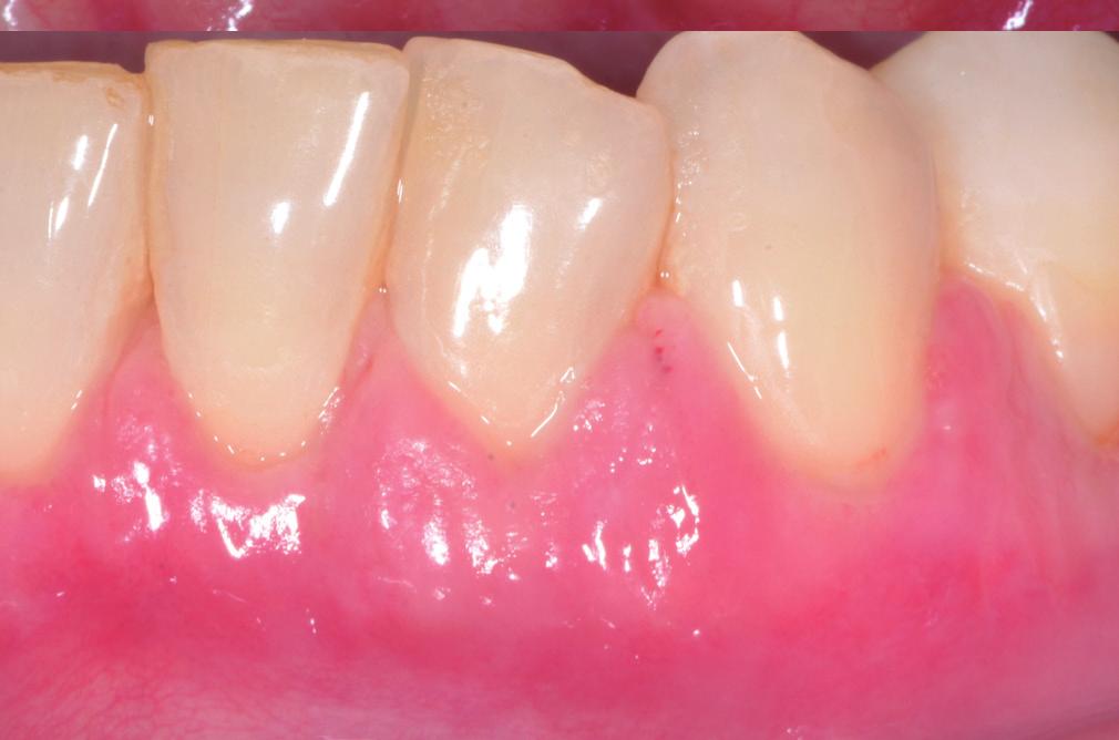 Different surgical strategies are useful to improve the amount of keratinized tissue around dental