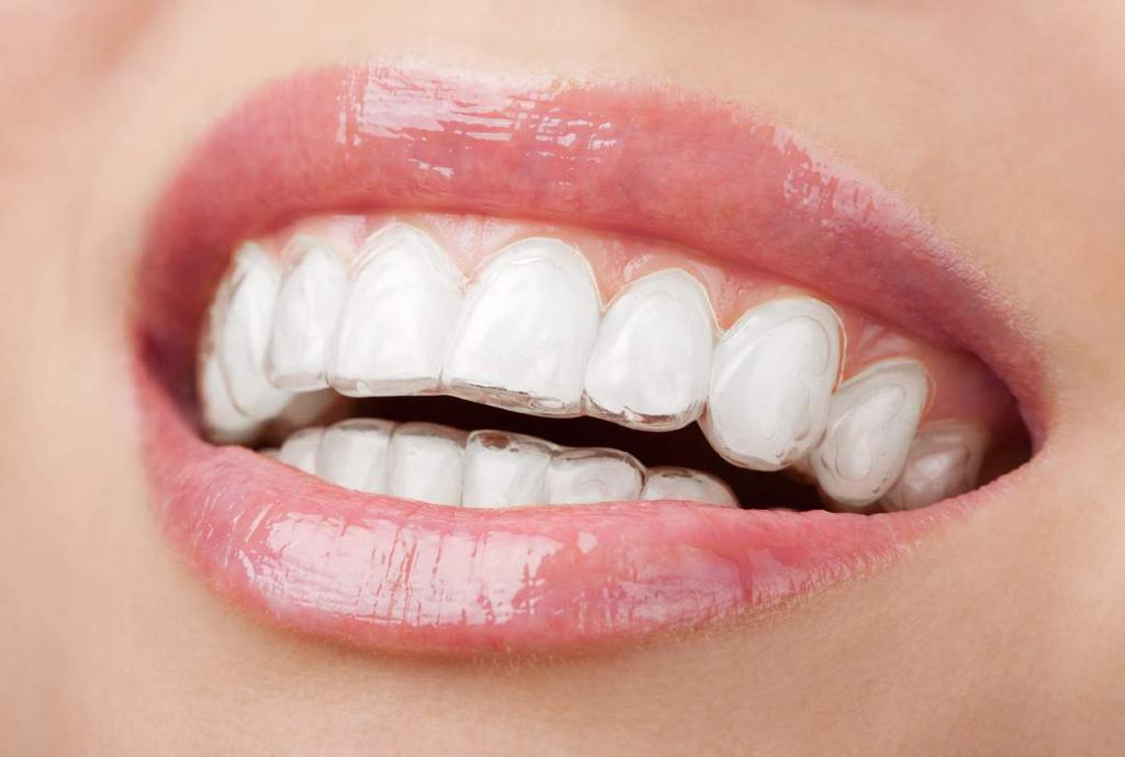 INVISALIGN WITH THE DR ANTHONY SPINK DENTAL SUITE GONE ARE THE DAYS OF WIRE BRACES With all treatments regarding your oral health, it s important to research as much as you can.