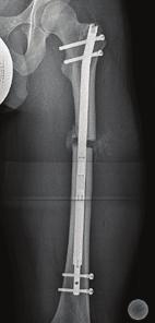 In a normally aligned limb, intramedullary lengthening along the anatomical axis of the femur results in a lateral shift of the