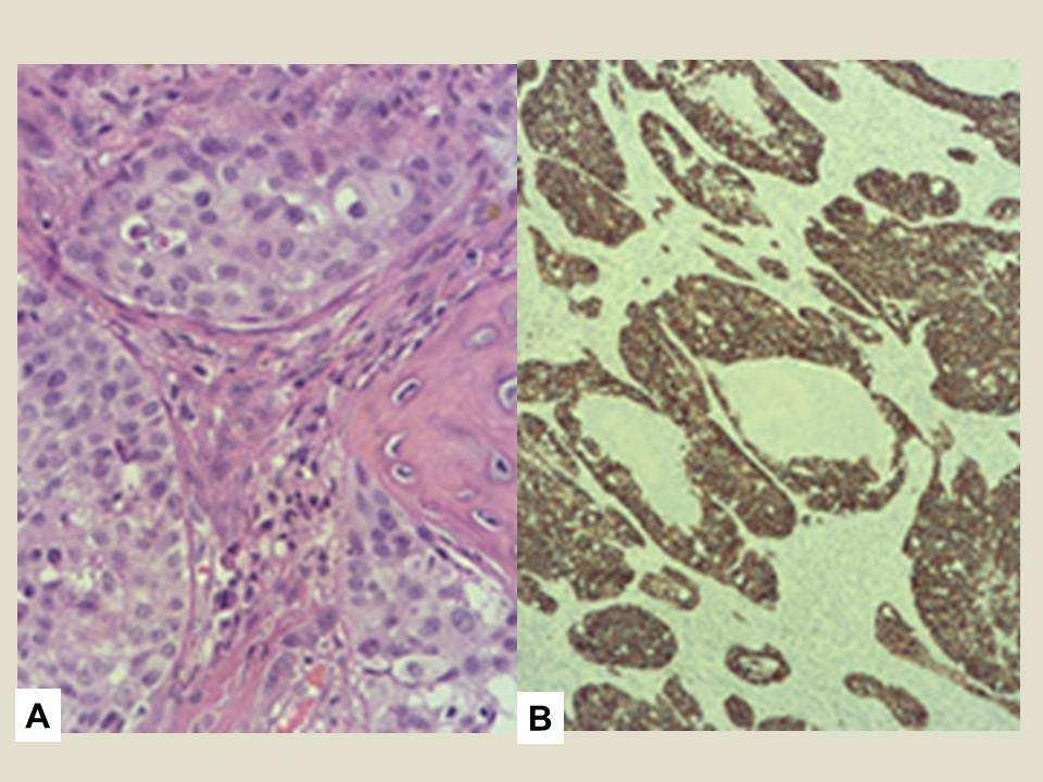 278 279 280 281 282 Figure 5: (A) Histology of mass at 400x view shows nested malignant cells