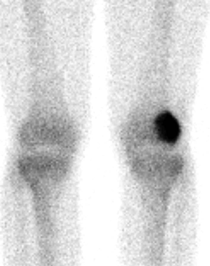(a) Coronal proton density-weighted image with fat suppression demonstrated an expansile heterogeneous mass in lateral aspect of the metaphysis of the distal femur extending to the
