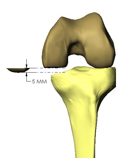 The anterior/posterior alignment of the femoral component can