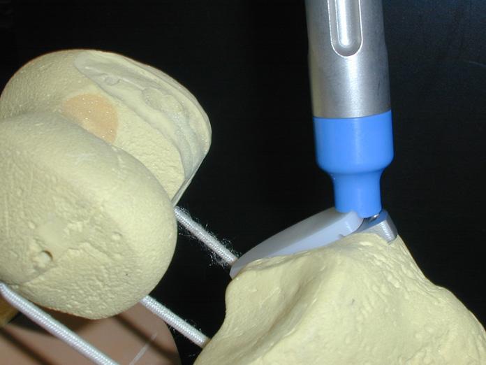 Impact the insert into the tibial tray.