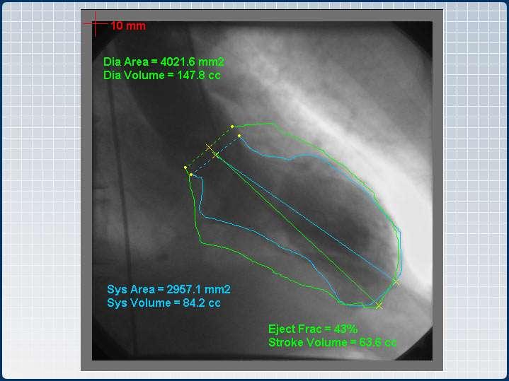 Angiographic Cardiac Output SV=LVEDV-LVESV SV = 148 84 SV = 64 cc s If HR is 80 CO =