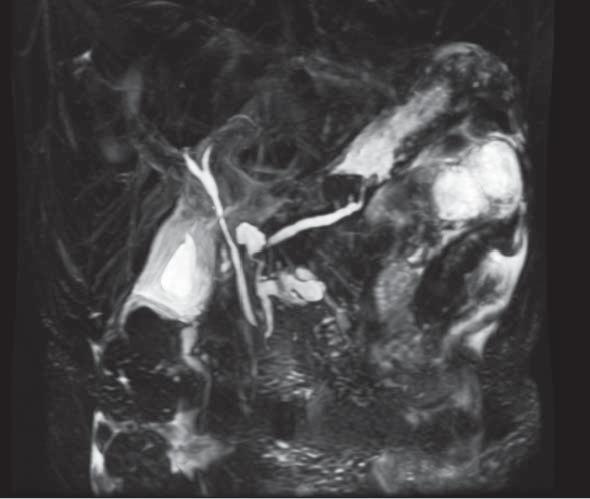 5 cm x 2 cm x 2 cm without infiltrating compromise or lymphovascular or peri-neural invasion. The margins of the section tumor-free, and the lymph nodes were negative for malignancy (Figure 4).