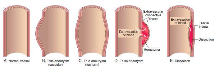 Aneurysms, classification according to shape