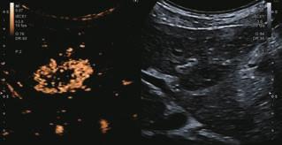 demonstrated high vascularity. Focal liver lesions can be clearly seen on non-contrast ultrasound with good image quality.
