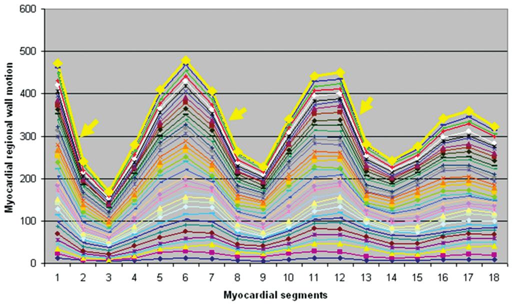 Impaired Regional Myocardial Function Detection Using the Standard Inter-Segmental Integration The regional wall motion integration pattern of LV myocardium P in normal patients M D AHA