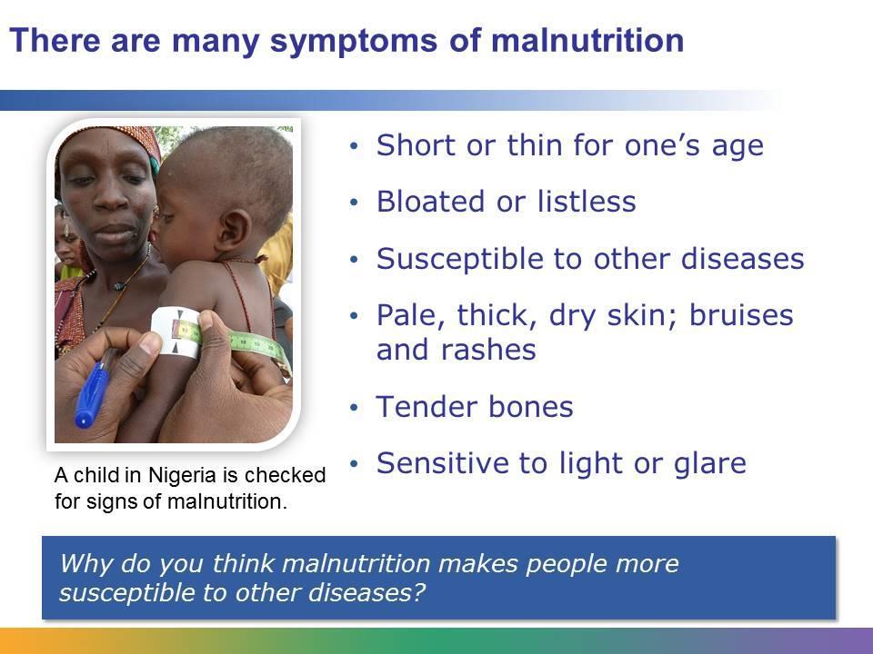 Malnourished children may exhibit many different types of symptoms. They may be short for their age or they may be thin. They may be bloated or listless.