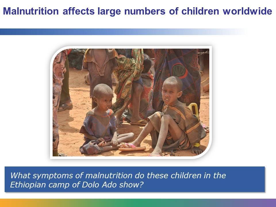 Most people arriving at Dolo Ado refugee camp in Ethiopia have little or no possessions or food. Children are especially at risk. Almost 50% of them are acutely malnourished.
