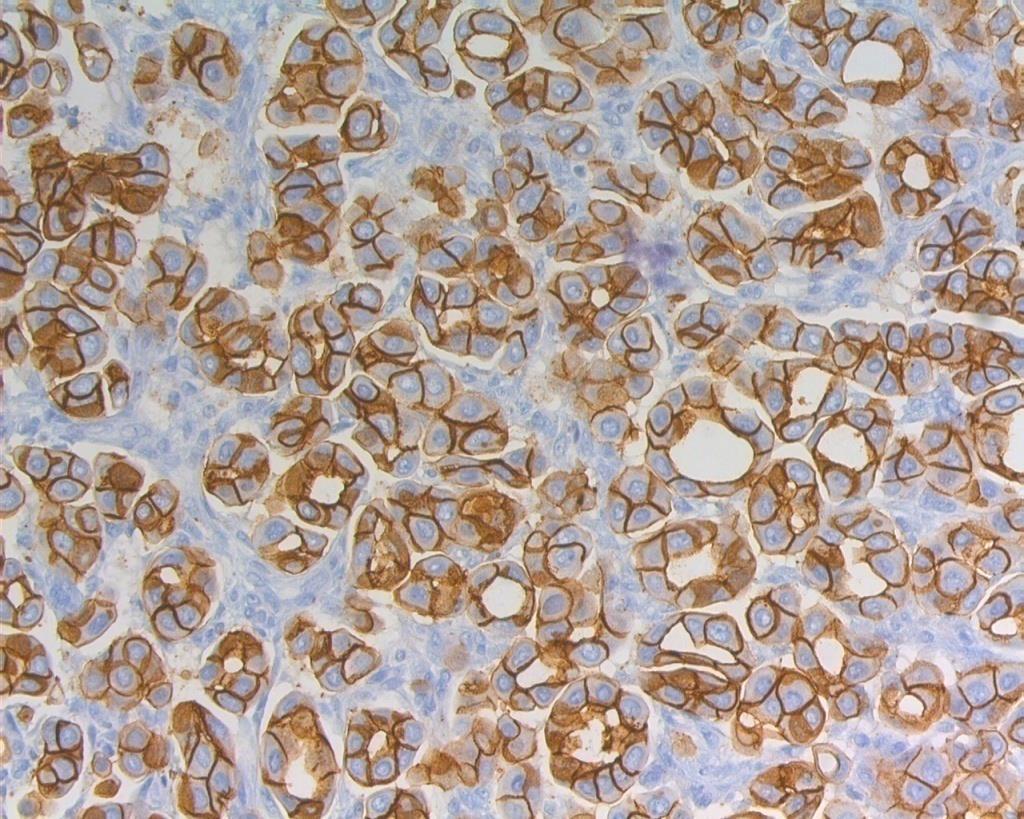 Tumour cells