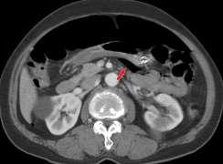 CASE REPORT A 69 year old man with a 5 year history of severe Churg Strauss Syndrome (CSS) was admitted to emergency department because of abdominal pain, respiratory and cardiac insufficiency and a