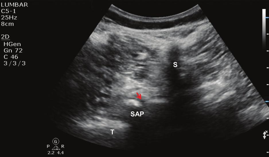 4 To date, most clinical studies on the use of sonography for neuraxial blocks in regional anesthesia describe the use of sonography for preprocedural establishment of important landmarks.