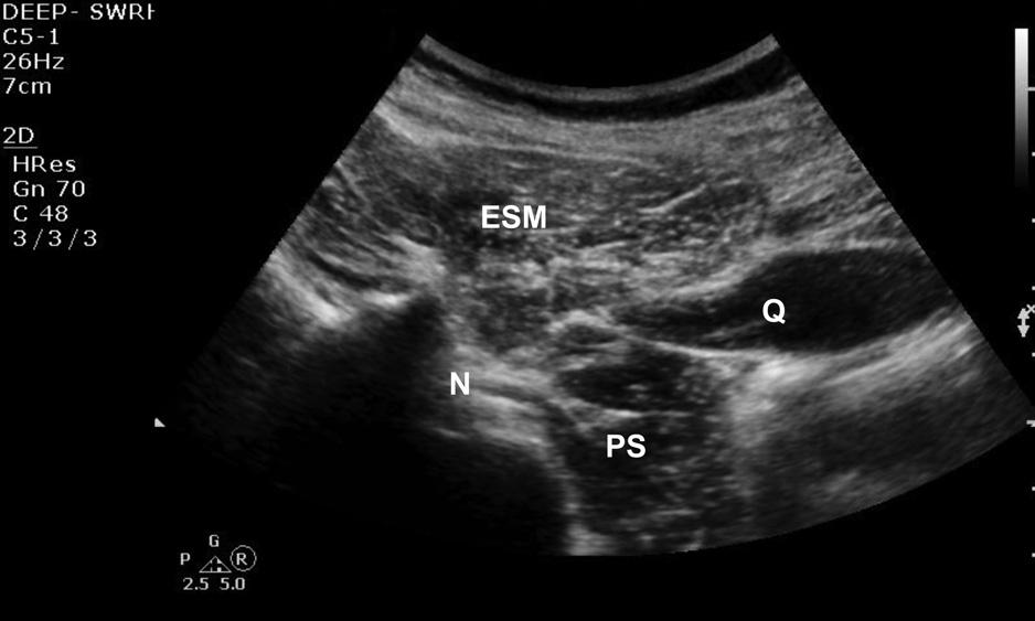 In addition, sonography allows for estimation of both the depth to the epidural and intrathecal spaces and the angle of needle insertion, which enhance the performance of spinal and epidural needle