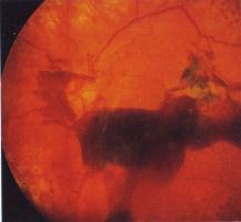 Diabetic retinopathy Retinal cells are very susceptible to hypoxia OSA causes recurrent hypoxia High prevalence of OSA in diabetics with