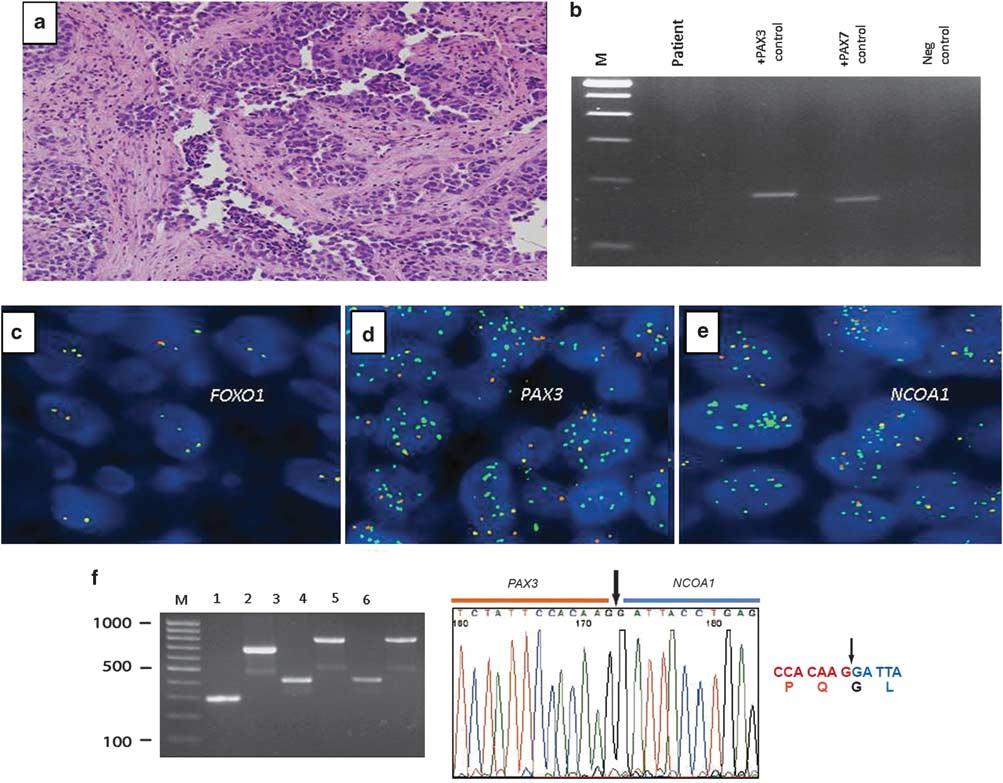 S90 Molecular diagnostics of soft-tissue tumors Figure 4 (a) Alveolar rhabdomyosarcoma histologic pattern with loss of cellular cohesion in a PAX3 NCOA1 variant case.