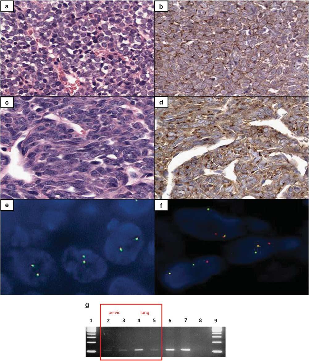 S88 Molecular diagnostics of soft-tissue tumors Figure 3 (a,b) Poorly differentiated synovial sarcoma arising in the pelvis with a small round cell morphologic appearance and CD99 immunohistochemical
