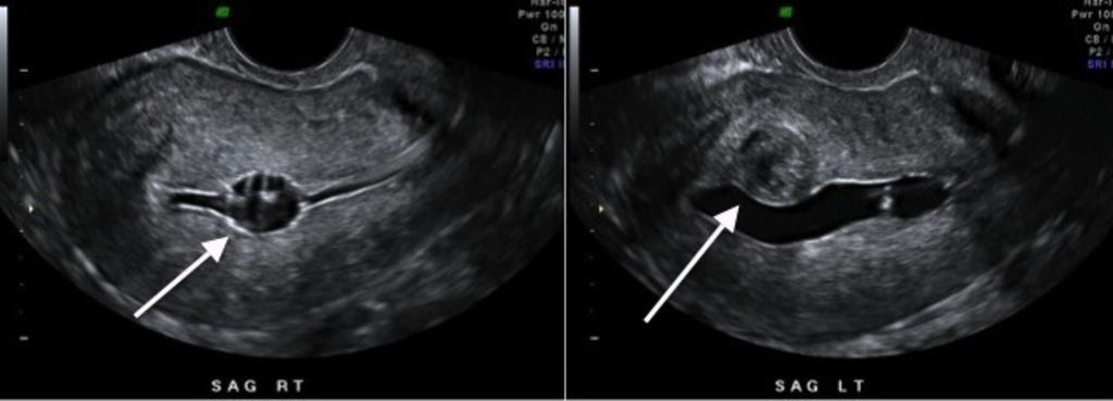 Fig. 9: US images from hysterosonogram showing a small