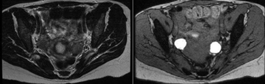 18: Axial T2, T1, T1 fat sat pre and post contrast MR images illustrating bilateral
