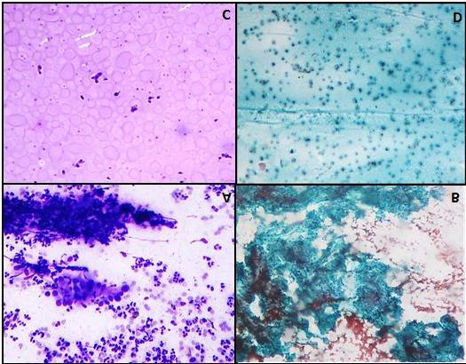 Aruna S.: Cytomorphological study of major salivary gland lesions: a 5year experience at a tertiary care center Salivary gland lesions (n=65) Figure 3.