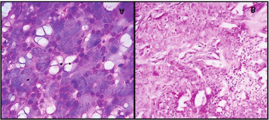 sialadenitis() Pleomorphic adenoma(6) 6 Oncocytoma() Acinic cell carcinoma() Mucoepidermoid carcinoma() oncocytoma and each of mucoepidermoid carcinoma and acinic cell carcinoma (Figure 8 and 9).