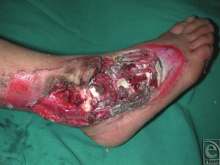 ELSHAHAT Figure 1. Complex avulsion injury of the dorsum of the right foot and ankle in an 8-year-old child.