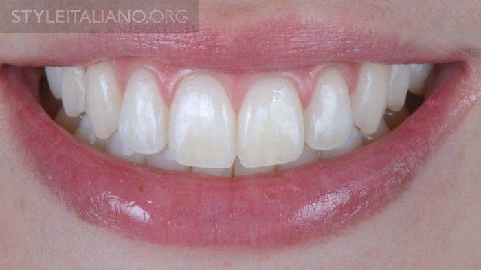 19 Final Result : Intra-oral picture 20 Final Result : Smile Picture To conclude, First This minimal invasive treatment of fluorosis spots of enamel is very easy to do : the crucial moment in the