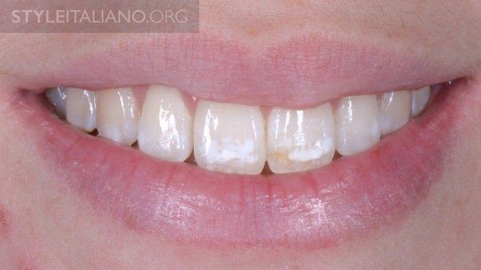 1 Initial frontal Smile picture : The prophylactic dose of fluoride appears to
